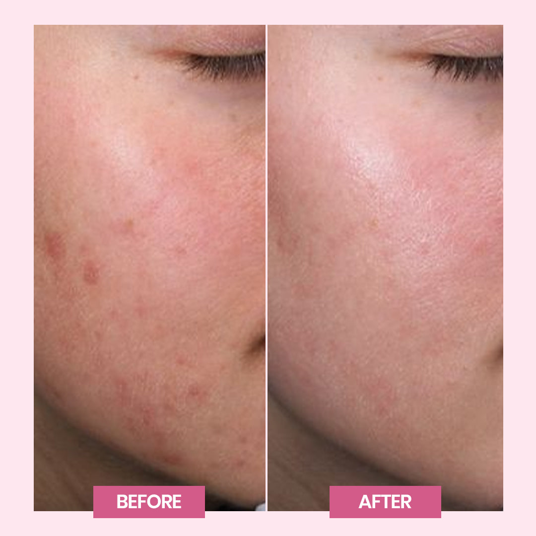 acne plus face wash result
